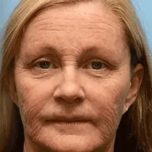 ADNOON™ Botox Skin Treatment Cream